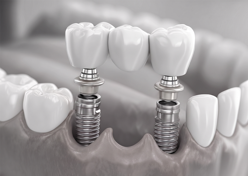 implant supported bridge