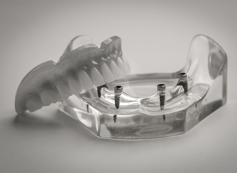implant supported denture